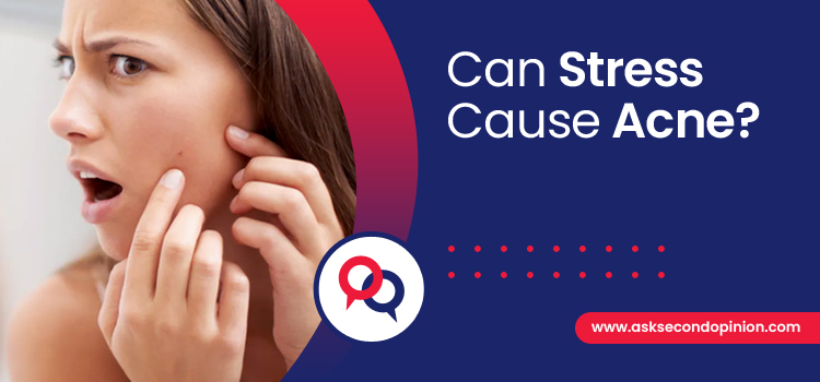 can-stress-cause-acne-second-opinion
